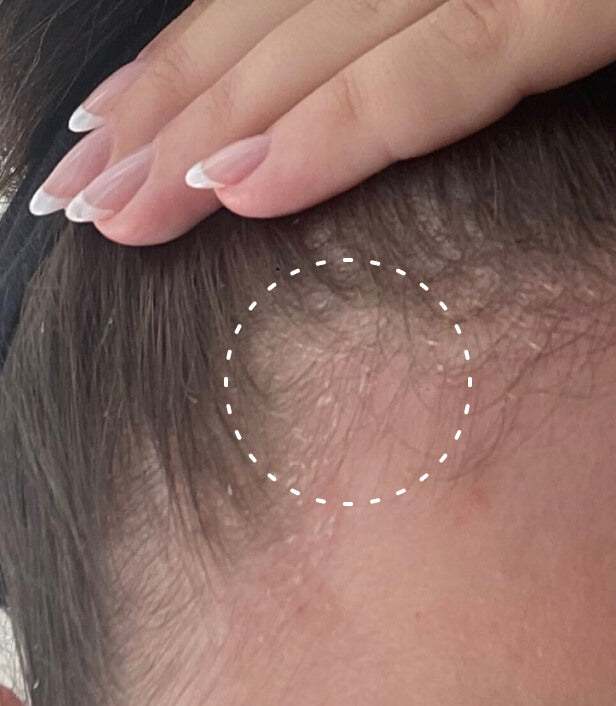 Image of a person's scalp line where their psoriasis has healed